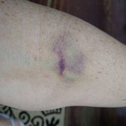 Big South Fork Medical - The result of a terrible IV