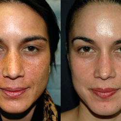 Facial Architect - Vi Peel Before/After