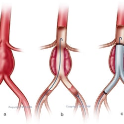Dr. Michael H Chu - Incisionless Treatment of Abdominal aortic Aneurysm