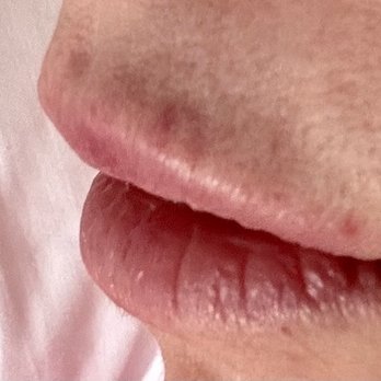 StudioMD - Ugh L side is so bad. - Laser Hair Removal Near Me - New York, New York