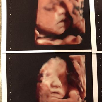 Fun Fetal Photos - Side profiles (31 weeks) - Diagnostic Imaging Near Me - Hampton, Virginia Fun Fetal Photos - Side profiles (31 weeks) - Diagnostic Imaging Near Me - Hampton, Virginia