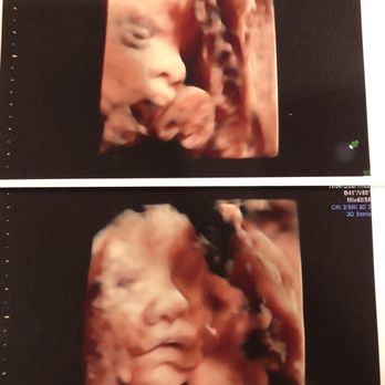 Fun Fetal Photos - Eyes open on top, baby face (31 weeks) - Diagnostic Imaging Near Me - Hampton, Virginia Fun Fetal Photos - Eyes open on top, baby face (31 weeks) - Diagnostic Imaging Near Me - Hampton, Virginia