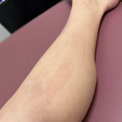 Waxing The City - Discoloration after 2 weeks... no improvement.