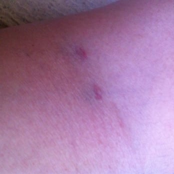 Quest Diagnostics - Poke 2 and 3!!! Can't wait until they turn big ol' purple from the awful vein fishing that tech did. So angry!!! - Laboratory Testing Near Me - Las Vegas, Nevada