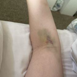 Internal Medicine Specialists of Southern Nevada - My arm only on yesterday (7/27) I got labs drawn 7/22