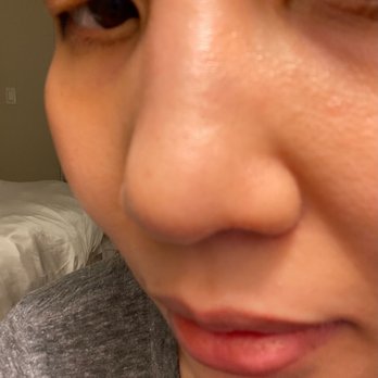 The Peel Connection - pores look a lot smaller, skin on nose look so much smoother. - Skin Care Near Me - Beverly Hills, California The Peel Connection - pores look a lot smaller, skin on nose look so much smoother. - Skin Care Near Me - Beverly Hills, California