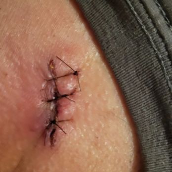 Serene Surgical - This is after being cleaned up, in the ER and given antibiotics! - Surgeons Near Me - Doral, Florida Serene Surgical - This is after being cleaned up, in the ER and given antibiotics! - Surgeons Near Me - Doral, Florida