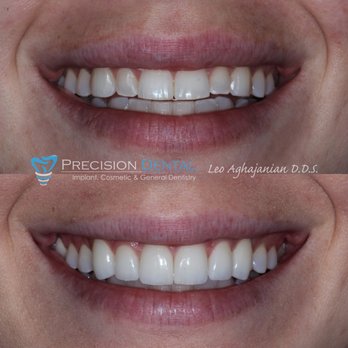 Leo Aghajanian, DDS - Precision Dental - Dr. Leo was able to achieve an amazing smile makeover using ceramic crowns. Our patient was ecstatic with her results. - General Dentistry Near Me - Glendale, California Leo Aghajanian, DDS - Precision Dental - Dr. Leo was able to achieve an amazing smile makeover using ceramic crowns. Our patient was ecstatic with her results. - General Dentistry Near Me - Glendale, California