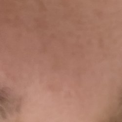 Aloha Spa, Nails & Massage - Severe rash after a very aggressive eye brow waxing and plucking session.