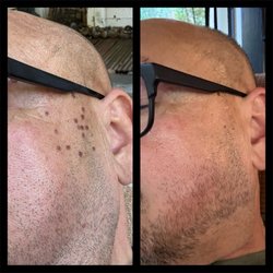 Allume Med Spa - Before and after 1 week treatment.