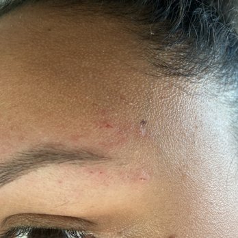 Eyebrows R Us - Ripped skin from poor threading. - Eyebrow Services Near Me - Las Vegas, Nevada Eyebrows R Us - Ripped skin from poor threading. - Eyebrow Services Near Me - Las Vegas, Nevada