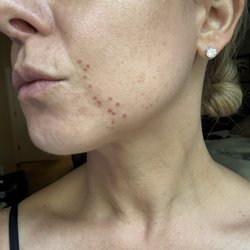 Najia's Skincare & Laser Center - Face laser