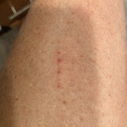 Brandywine Bartending School - More bites on legs