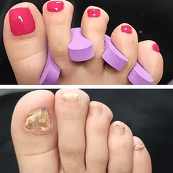 Specialized Pedicure for Fungal Nail care