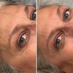 Microcurrent treatment
Before (left) after (right)