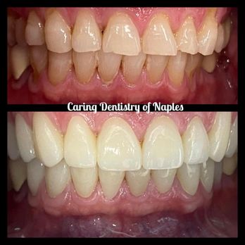 Caring Dentistry - Restorative work on patient with wear on the incisive surfaces due to chronic grinding. - General Dentistry Near Me - Naples, Florida Caring Dentistry - Restorative work on patient with wear on the incisive surfaces due to chronic grinding. - General Dentistry Near Me - Naples, Florida