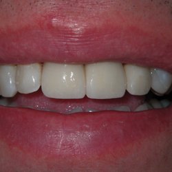 Arlington Comfort Dental - Three Porcelain Crowns placed