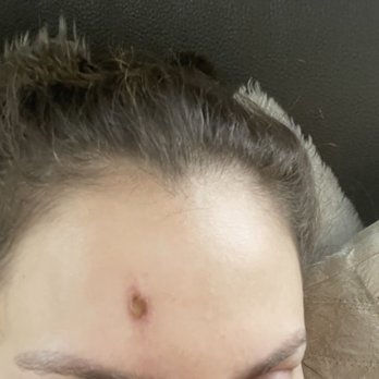 Raffy Karamanoukian, MD - This is the outcome I was left with the same day I got the laser treatment, my skin is burned and infected. - Cosmetic Surgeons Near Me - Santa Monica, California