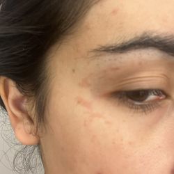 SOS WAX and Skincare - Summerlin - Skin burn