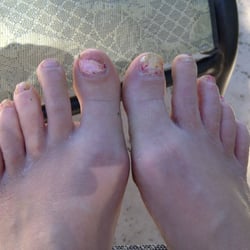 FootWorks Podiatry & Laser - This is the "before" picture. My feet, toes and toe nails were a mess!! So painful and itchy (and UGLY!!).
