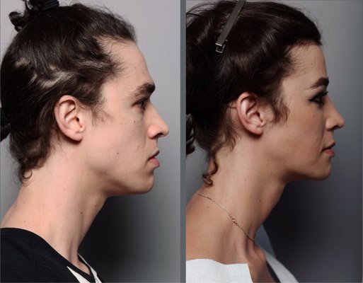 Photo of Deschamps-Braly Clinic of Plastic & Craniofacial Surgery - San Francisco, CA, US. Before vs 3 months post op