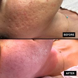 After just 1 session of Gua Sha + BDR Microneedling facial, ice pick acne scars are instantly smoothed with lasting benefits