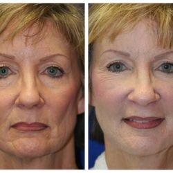 Chesapeake Plastic Surgery - Fat Grafting Before and After Results by Haven J. Barlow, MD, FACS