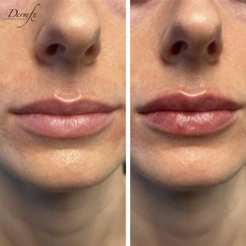 DermFx - Lip filler - Medical Spas Near Me - Newport Beach, California