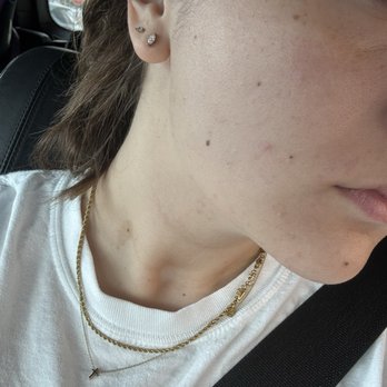 Beauti4Skin Medspa & Laser - Post whole mid and lower face LHR - Laser Hair Removal Near Me - Spring, Texas Beauti4Skin Medspa & Laser - Post whole mid and lower face LHR - Laser Hair Removal Near Me - Spring, Texas