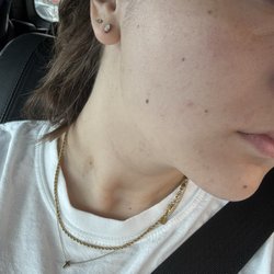 Beauti4Skin Medspa & Laser - Post whole mid and lower face LHR