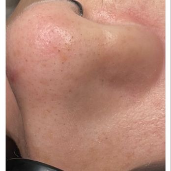 Skinfuzion - My nose before the hydra facial - Skin Care Near Me - Henderson, Nevada