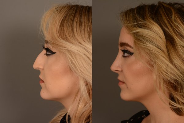 Rhinoplasty! - We offer Cosmetic, Hybrid, Revision, and Ethnic Rhinoplasty procedures! Rhinoplasty! - We offer Cosmetic, Hybrid, Revision, and Ethnic Rhinoplasty procedures!