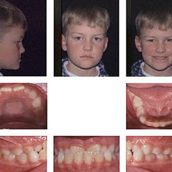 Guildford Orthodontic Centre - Before - Orthodontists Near Me - Surrey, British Columbia