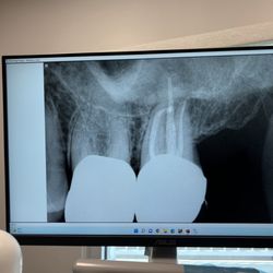 South Coast Endodontics - After the procedure you can see how well they got into the little root canals. The big white in the lower edge of the photo are my crowns.