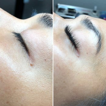 Palmer Aesthetics - Before and after - Skin Care Near Me - Tampa, Florida Palmer Aesthetics - Before and after - Skin Care Near Me - Tampa, Florida