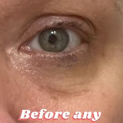 Before And After Salon - Before filler