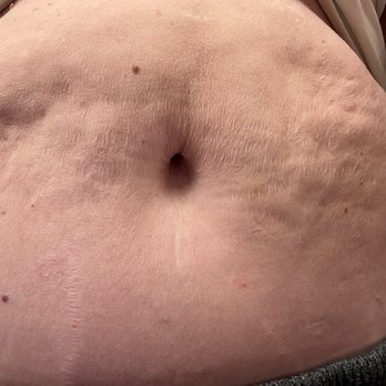 Newvue Plastic Surgery - The ultra smooth results of my Lipo/ lower body lift, he said the results are something I did to myself. - Cosmetic Surgeons Near Me - Bellevue, Washington Newvue Plastic Surgery - The ultra smooth results of my Lipo/ lower body lift, he said the results are something I did to myself. - Cosmetic Surgeons Near Me - Bellevue, Washington