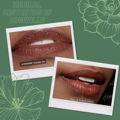 Juvederm Lip Filler - Achieve the kissable lips you deserve! Juvederm Lip Filler - Achieve the kissable lips you deserve!
