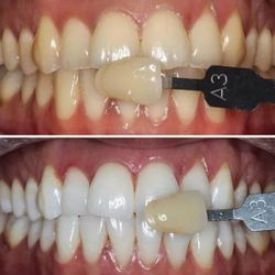 Beach & West Dental - Before and after picture of teeth Whitening .