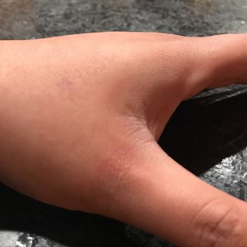 McDonald's - Hours later and my hand is still burning and red. - Fast Food Near Me - Oakley, California