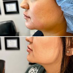 Posh Medical Spa - Jawline Contour and Lip augmentation. 2 syringes of Juvederm filler