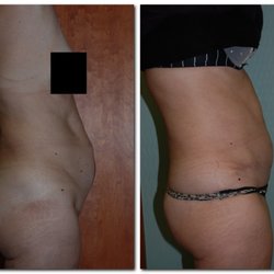 Wellesley Cosmetic Surgery - Before and after an abdominoplasty (tummy Tuck)