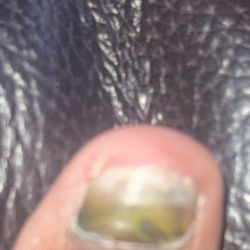 Right toe nail.