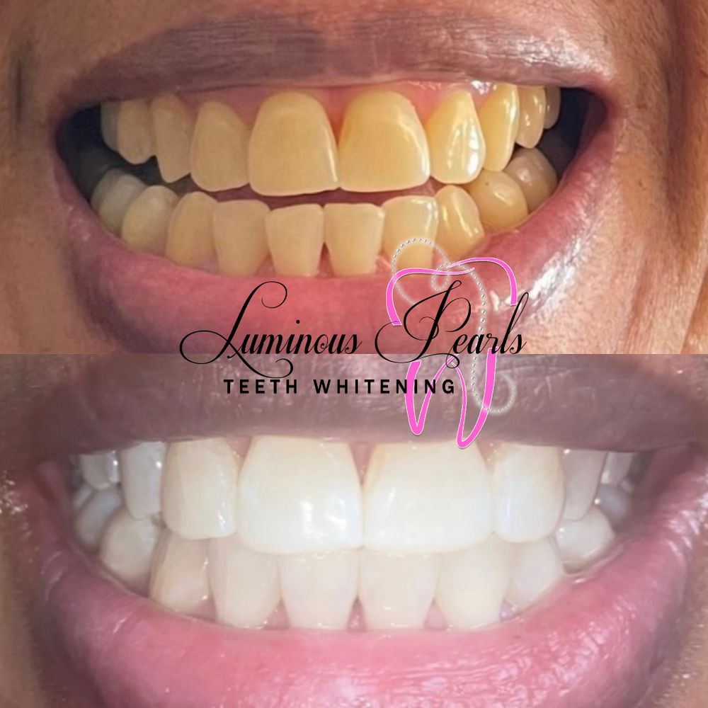 LUMINOUS PEARLS TEETH WHITENING Updated May 2024 Request an