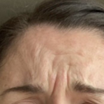 SpaDerma - Before Botox - Medical Spas Near Me - Chicago, Illinois