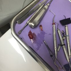 Arlington Family Dental Office - My rotten tooth lol