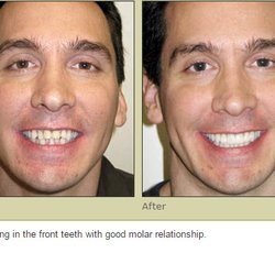 Seattle Dental Associates - Invisalign Results