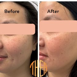 Thea Aesthetic - Power of VÌ Chemical peel!