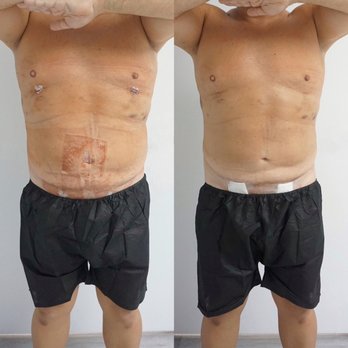 SkinSpired Aesthetics - 1 session of a post operative treatment. client was surgeon referred, lipo 360 male sculpting. - Medical Spas Near Me - Tampa, Florida SkinSpired Aesthetics - 1 session of a post operative treatment. client was surgeon referred, lipo 360 male sculpting. - Medical Spas Near Me - Tampa, Florida