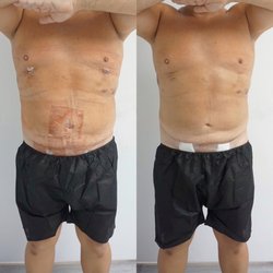 SkinSpired Aesthetics - 1 session of a post operative treatment. client was surgeon referred, lipo 360 male sculpting.